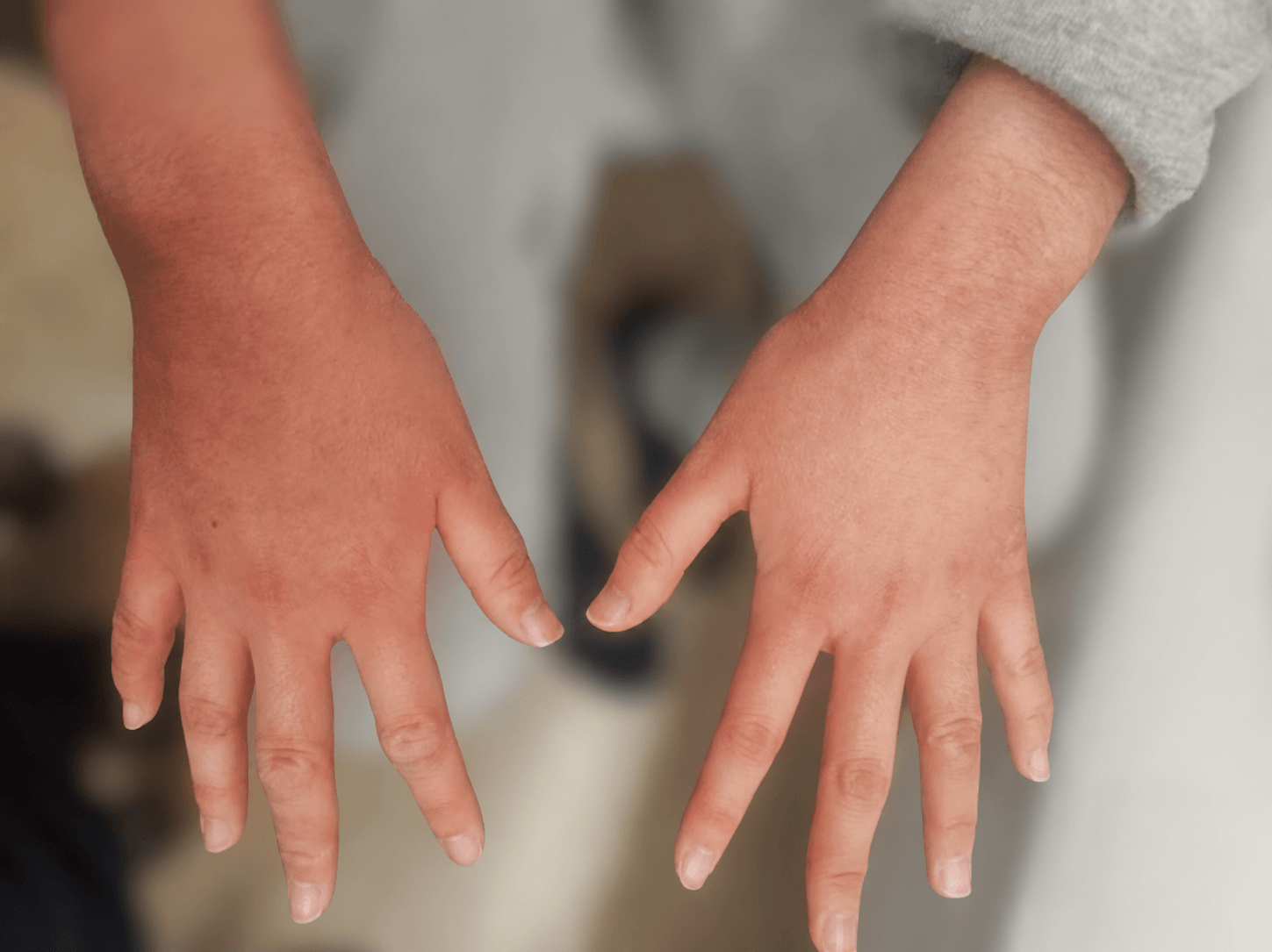 使用前：赤く腫れた手のアトピー性皮膚炎