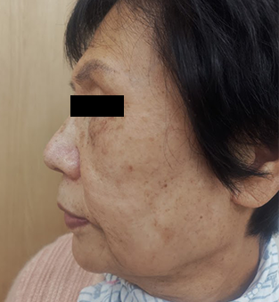 治療前の頬。シミが濃く広がっている状態