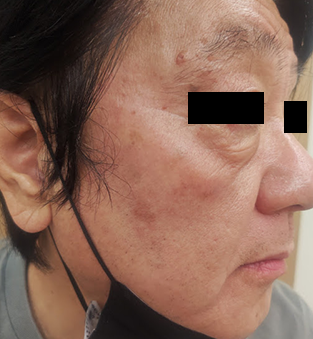 3週間後：全体的に美白効果が見られる肌