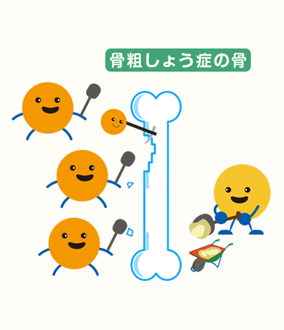 骨粗しょう症のイメージ2